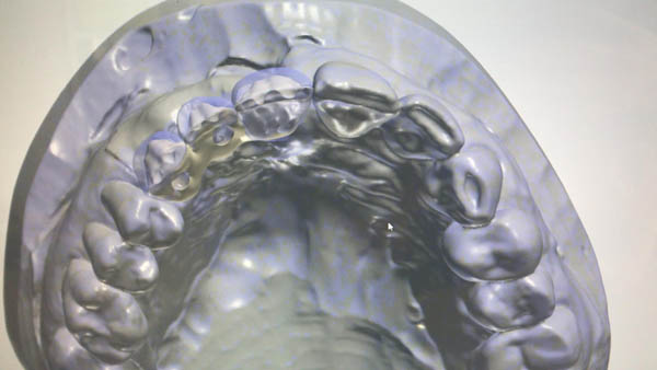 Implant Design 1