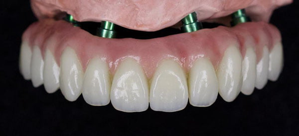 Bills implants 1
