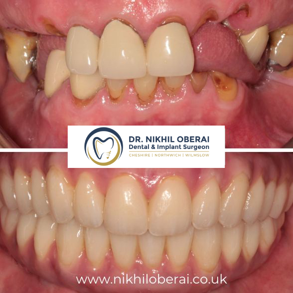 nikhil-dental-implants-before-and-after-9