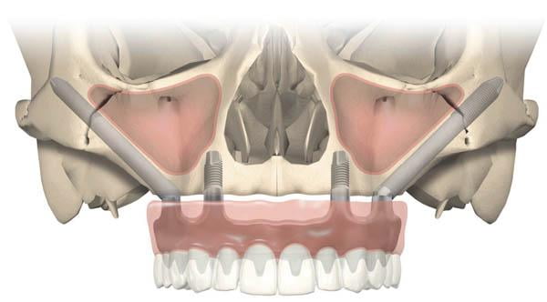 Zygomatic dental implants wilmslow & northwich