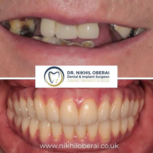 dental-implants-before-and-after-33
