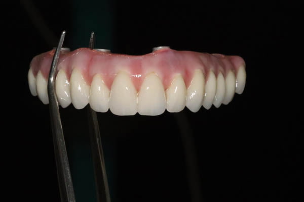 Multiple missing teeth Cheshire