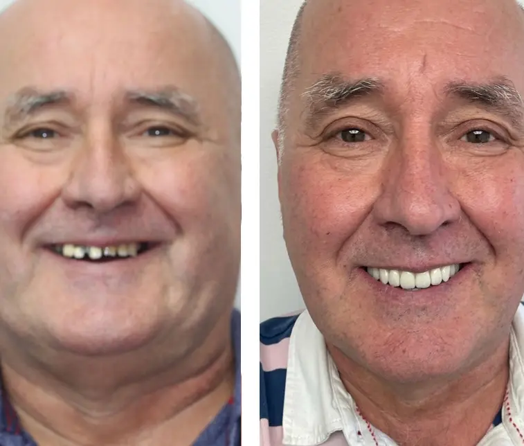 All on 4 Dental Implants Northwich