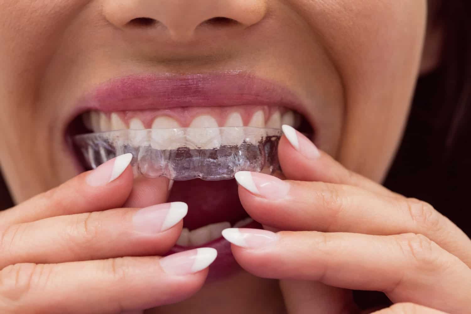 invisalign