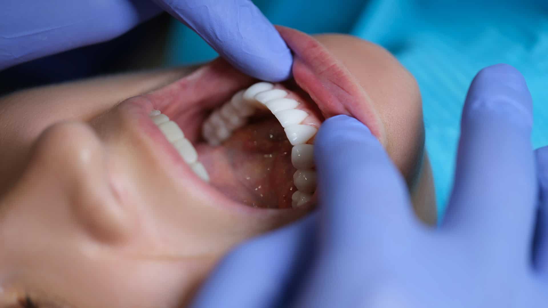 dental implants