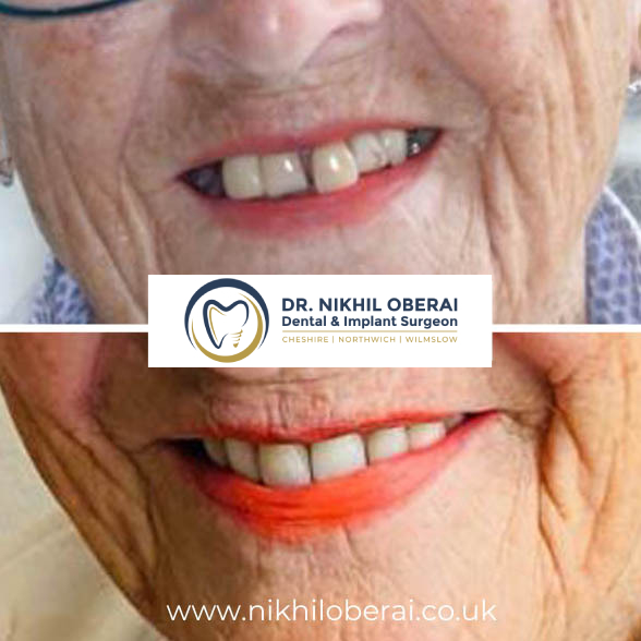dental-implants-before-and-after-6