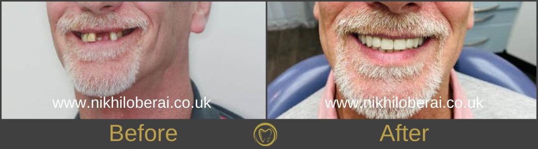 dental-implants-before-and-after-sidewards-2