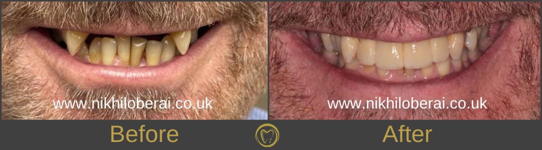 dental-implants-before-and-after-sidewards-2
