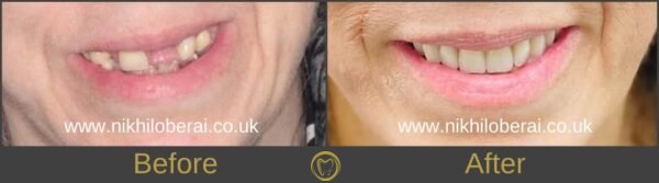 dental-implants-before-and-after-sidewards-3-600×167