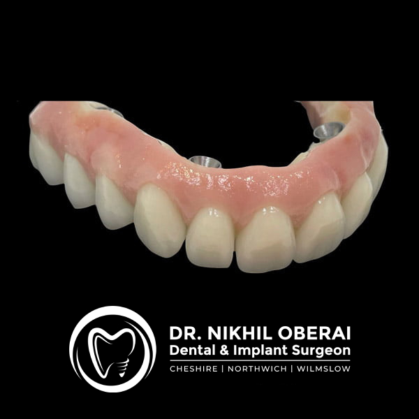 full-arch-dental-implants-northwich (1)