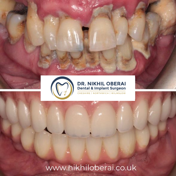 full-mouth-rehab-9