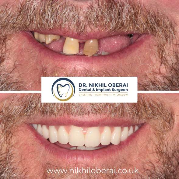 full-mouth-rehabilitation-before-and-after-1