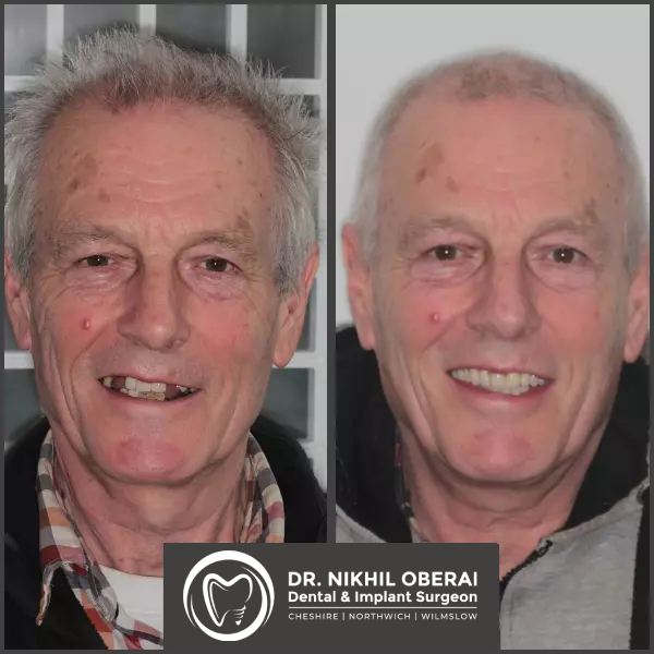 impants-before-and-after-1-1