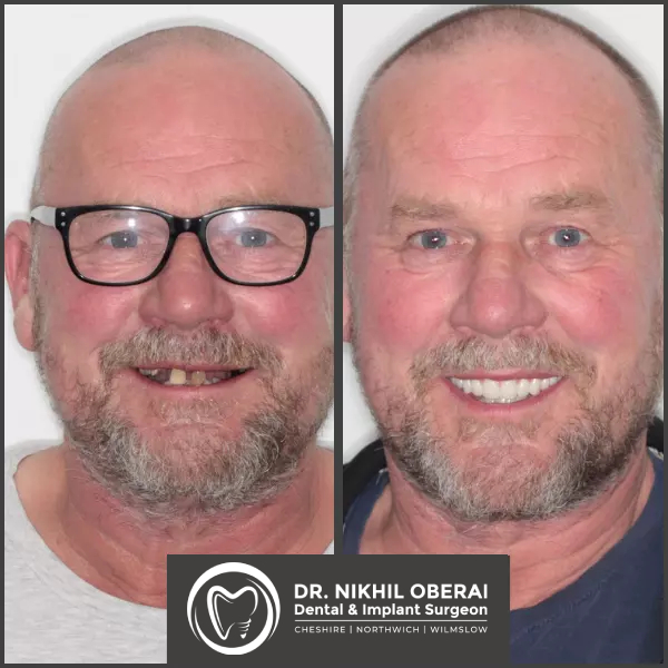 impants-before-and-after-3-1