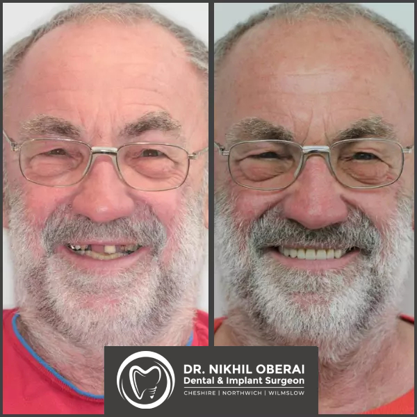 impants-before-and-after-4