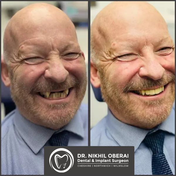 impants-before-and-after-6
