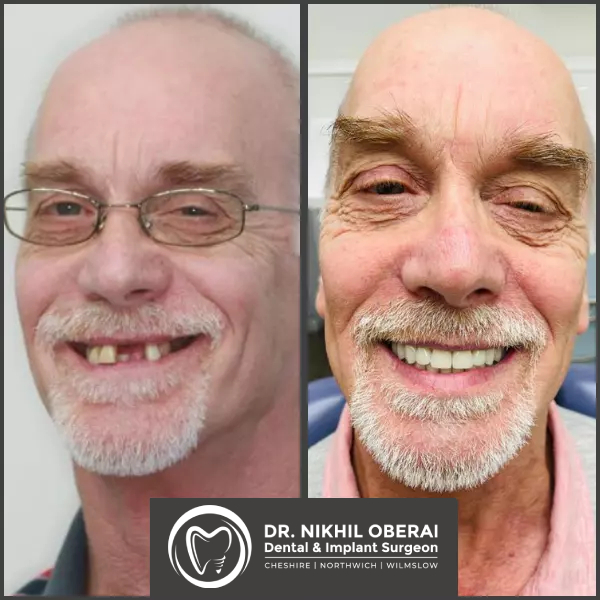 impants-before-and-after-9