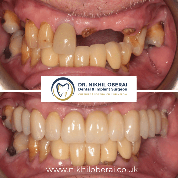 nikhil-before-and-after-implants-8
