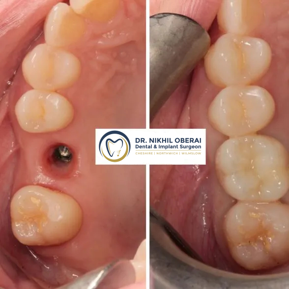 single-implant-before-and-after-6-1